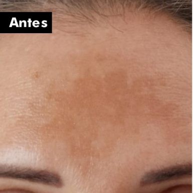 Antes e depois do clareamento de testa